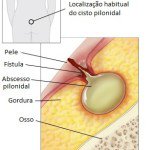 CISTO PILONIDAL – Causas, Sintomas e Cirurgia
