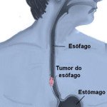 14 SINTOMAS DE CÂNCER