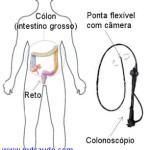 COMO É FEITO O EXAME DE COLONOSCOPIA