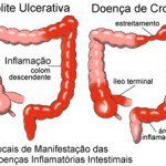 DOENÇA DE CROHN – RETOCOLITE ULCERATIVA