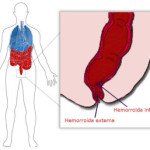 HEMORROIDES – Síntomas y tratamiento