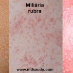 BROTOEJA NO BEBÊ – Causas e Tratamento