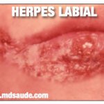 HERPES LABIAL TEM CURA?