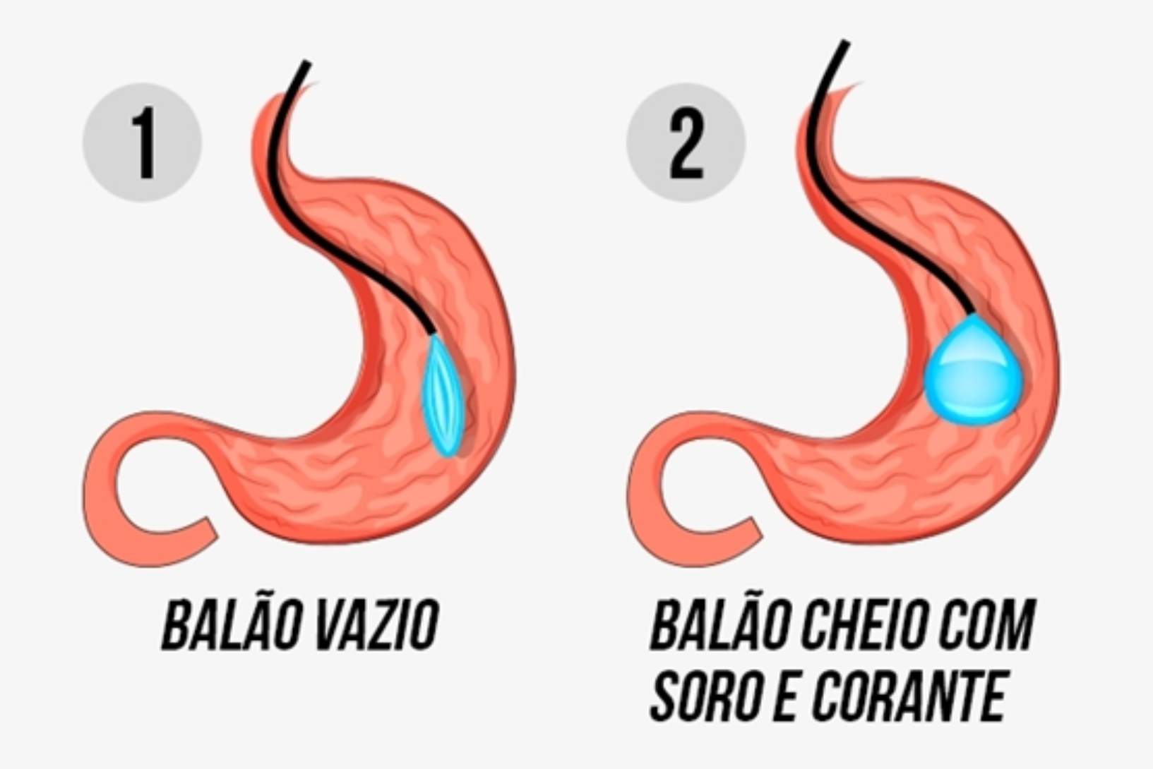 Balão Gástrico